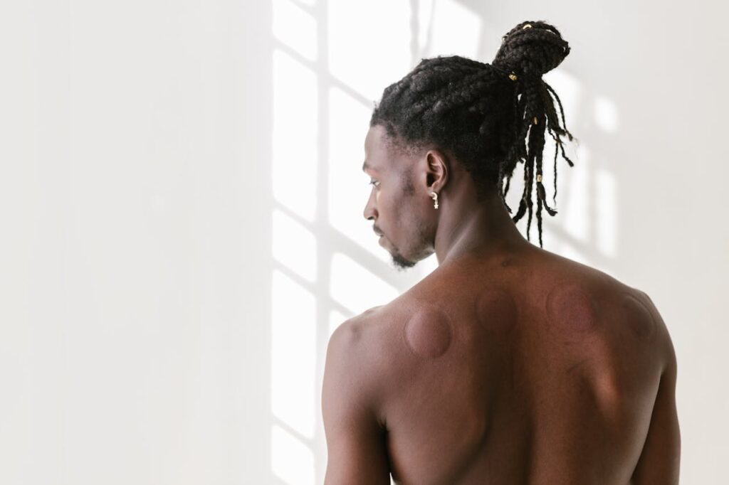 Shirtless man's back with circular cupping marks after cupping therapy with massage