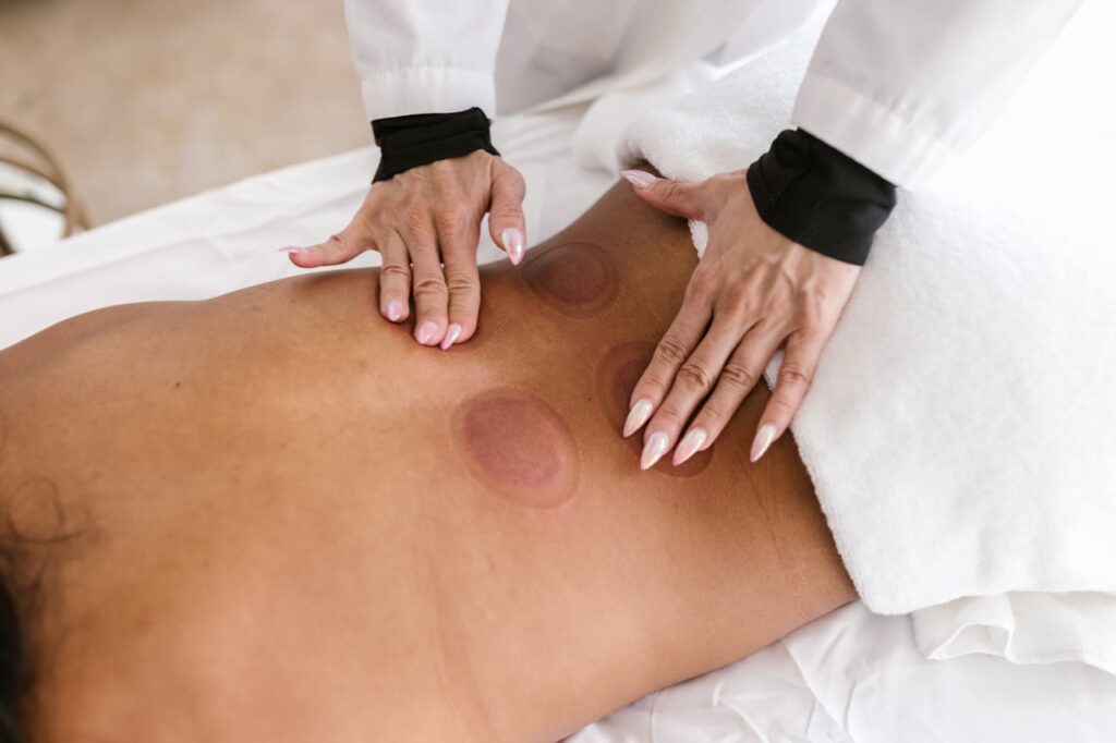 Women laying down during a massage treatment with light cupping marks on her lower back